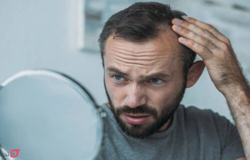 انواع ریزش مو و دلایل آن؛ نحوه تشخیص الگو و نوع ریزش با عکس 14 انواع ریزش مو