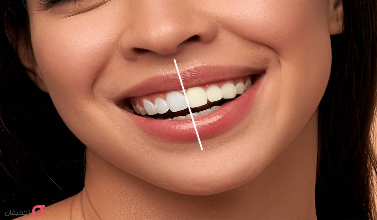 ماندگاری بلیچینگ دندان