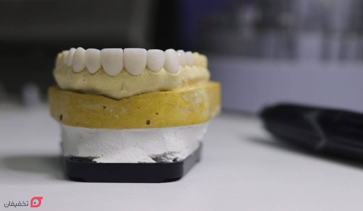 مراحل لمینت دندان با عکس | 11 مرحله با توضیح کامل و تصاویر 4 مراحل لمینت دندان با عکس