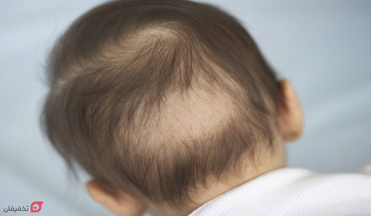 انواع ریزش مو و دلایل آن؛ نحوه تشخیص الگو و نوع ریزش با عکس 7 انواع ریزش مو در کودکان