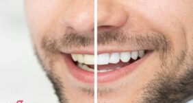 بلیچینگ دندان چقدر دوام دارد
