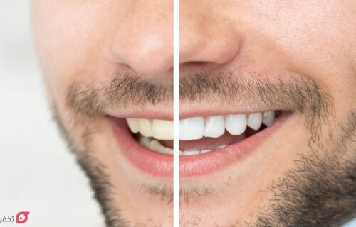بلیچینگ دندان چقدر دوام دارد