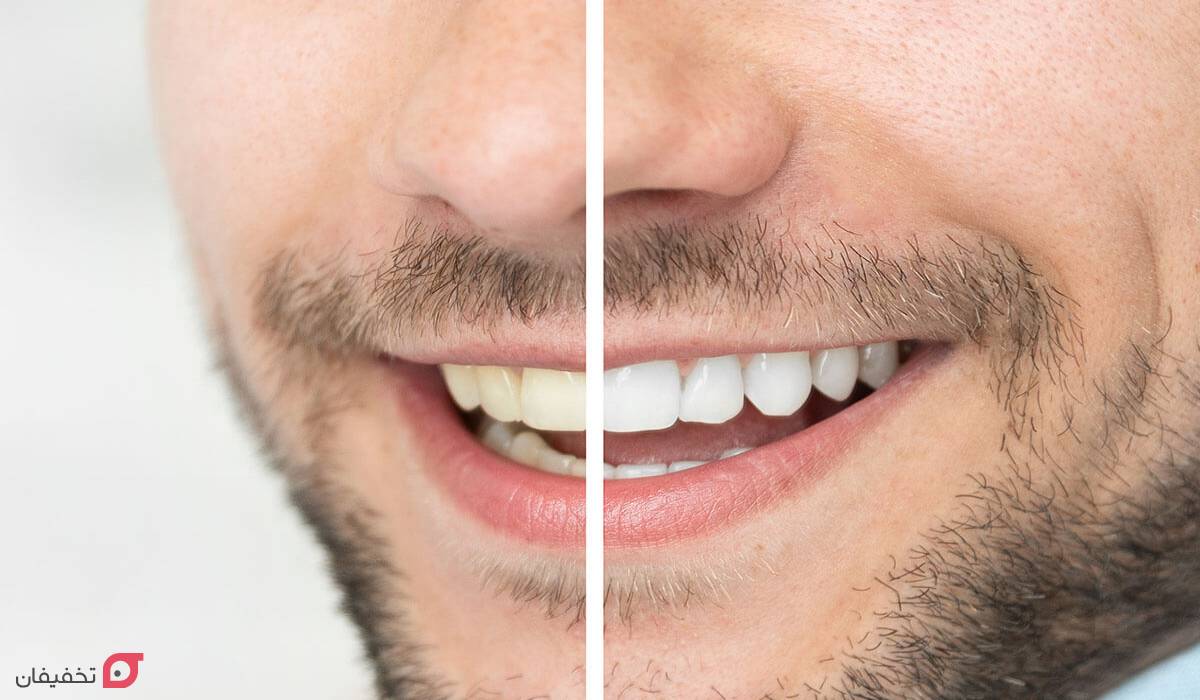 بلیچینگ دندان چقدر دوام دارد