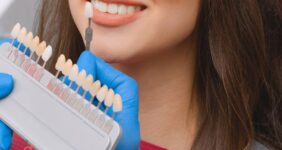 مراحل لمینت دندان با عکس