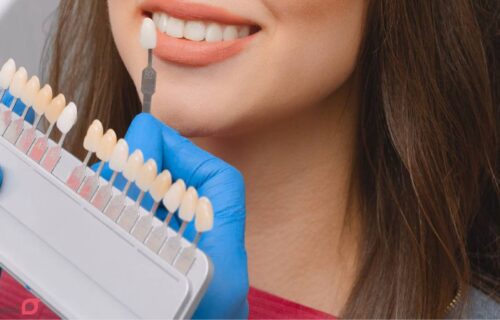 مراحل لمینت دندان با عکس | 11 مرحله با توضیح کامل و تصاویر 30 مراحل لمینت دندان با عکس