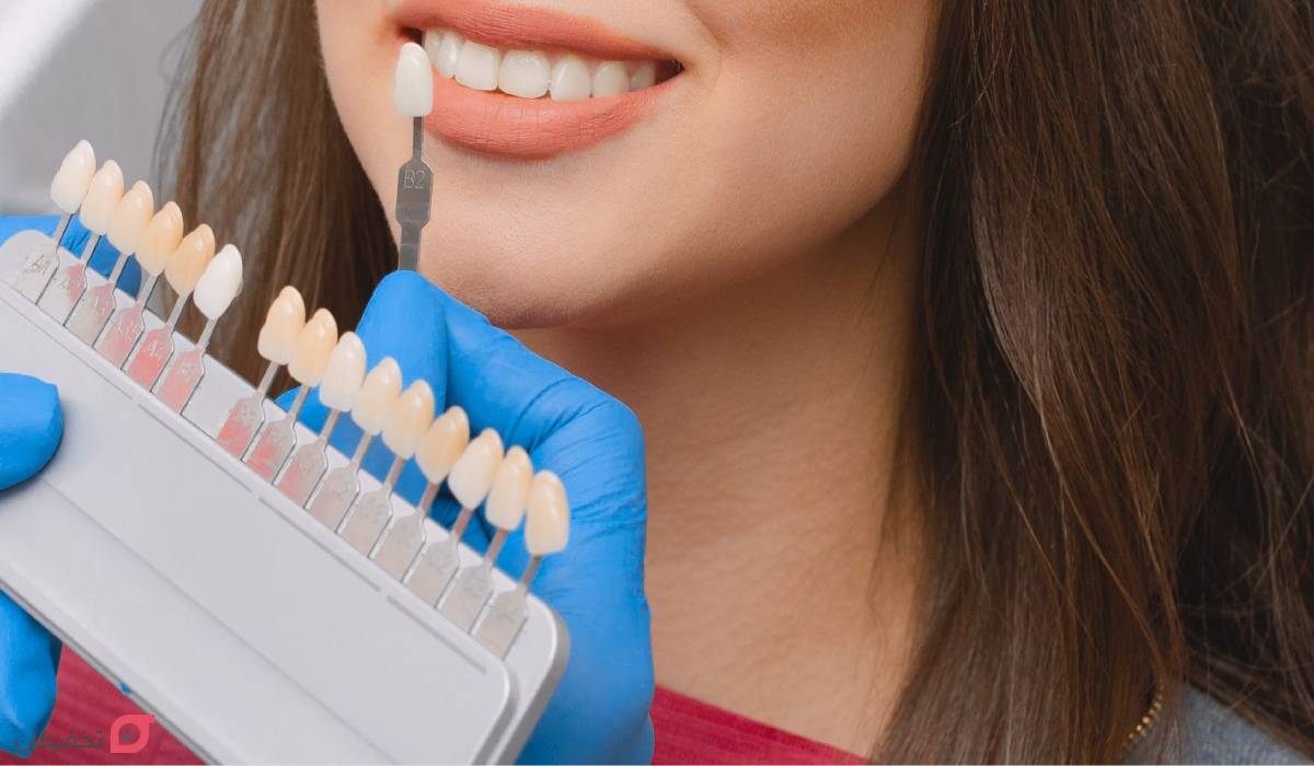 مراحل لمینت دندان با عکس