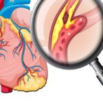 علائم چربی خون بالا در مردان | علت، عوارض و درمان 37 علائم چربی خون بالا در مردان