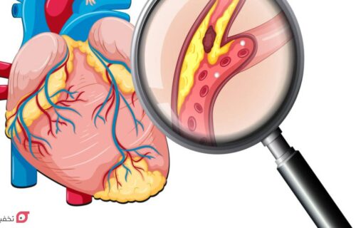 علائم چربی خون بالا در مردان | علت، عوارض و درمان 22 علائم چربی خون بالا در مردان