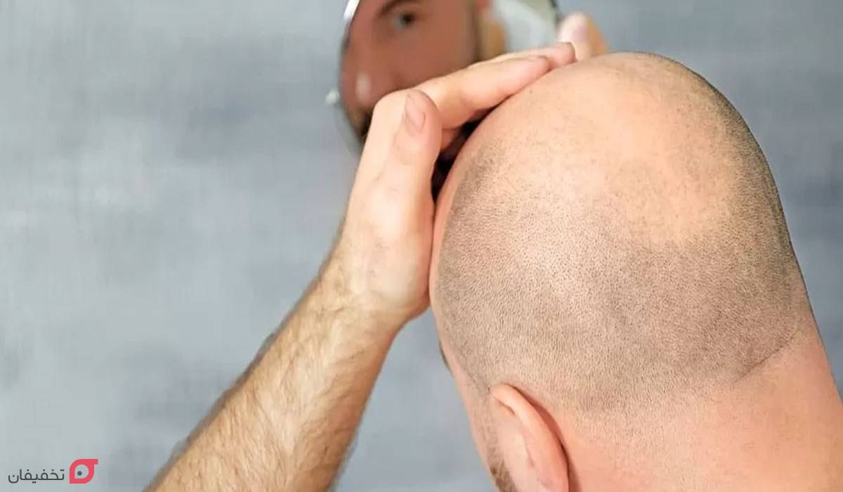 کاشت مو در شیراز بهتر است یا تهران | مقایسه هزینه و خدمات 7 کاشت مو در شیراز بهتر است یا تهران