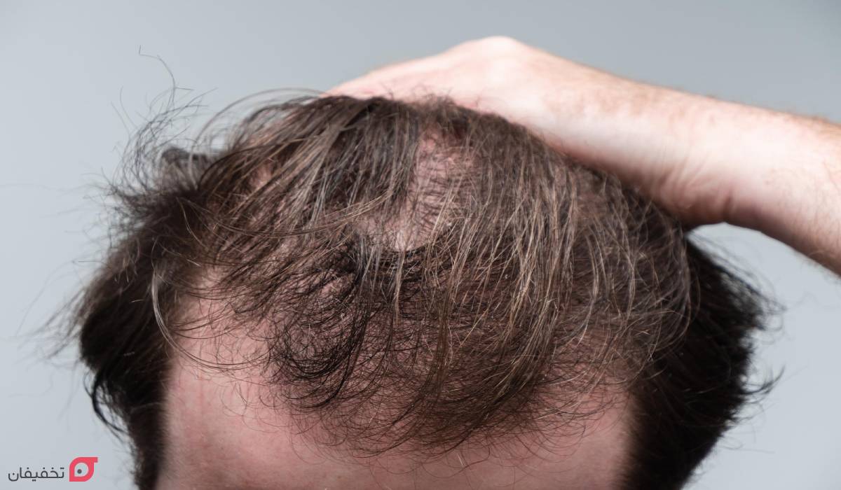 انواع ریزش مو و دلایل آن؛ نحوه تشخیص الگو و نوع ریزش با عکس 8 الگوی ریزش مو