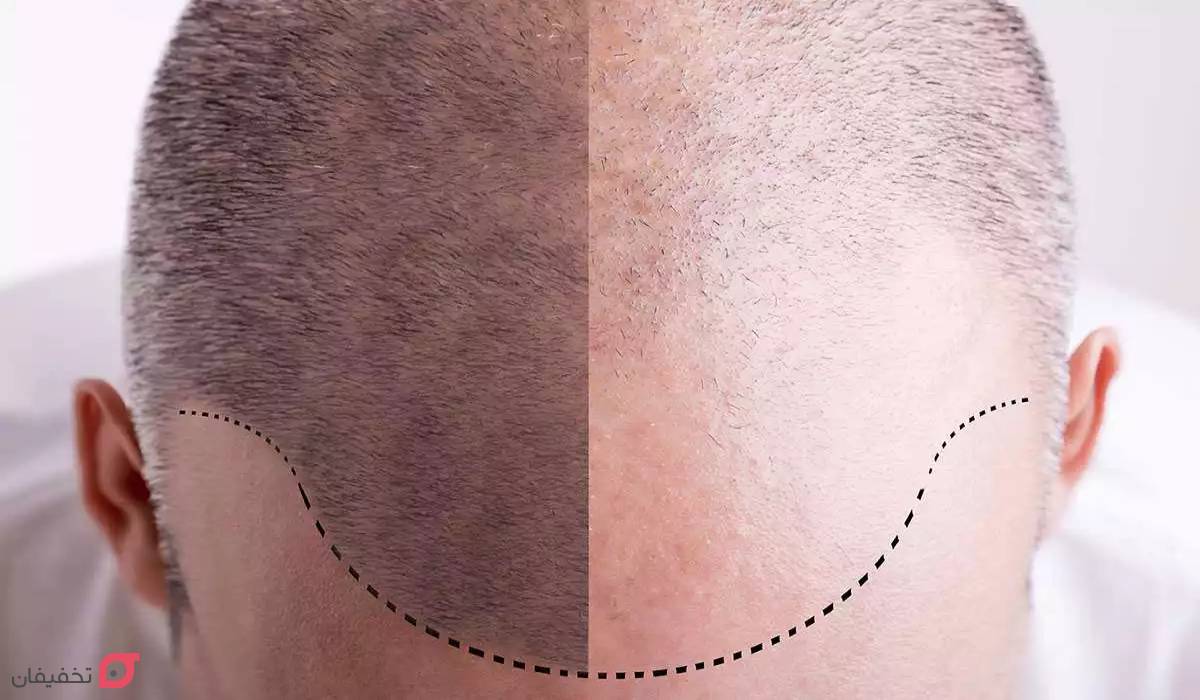 کاشت مو در شیراز بهتر است یا تهران | مقایسه هزینه و خدمات 4 کاشت مو در شیراز بهتر است یا تهران