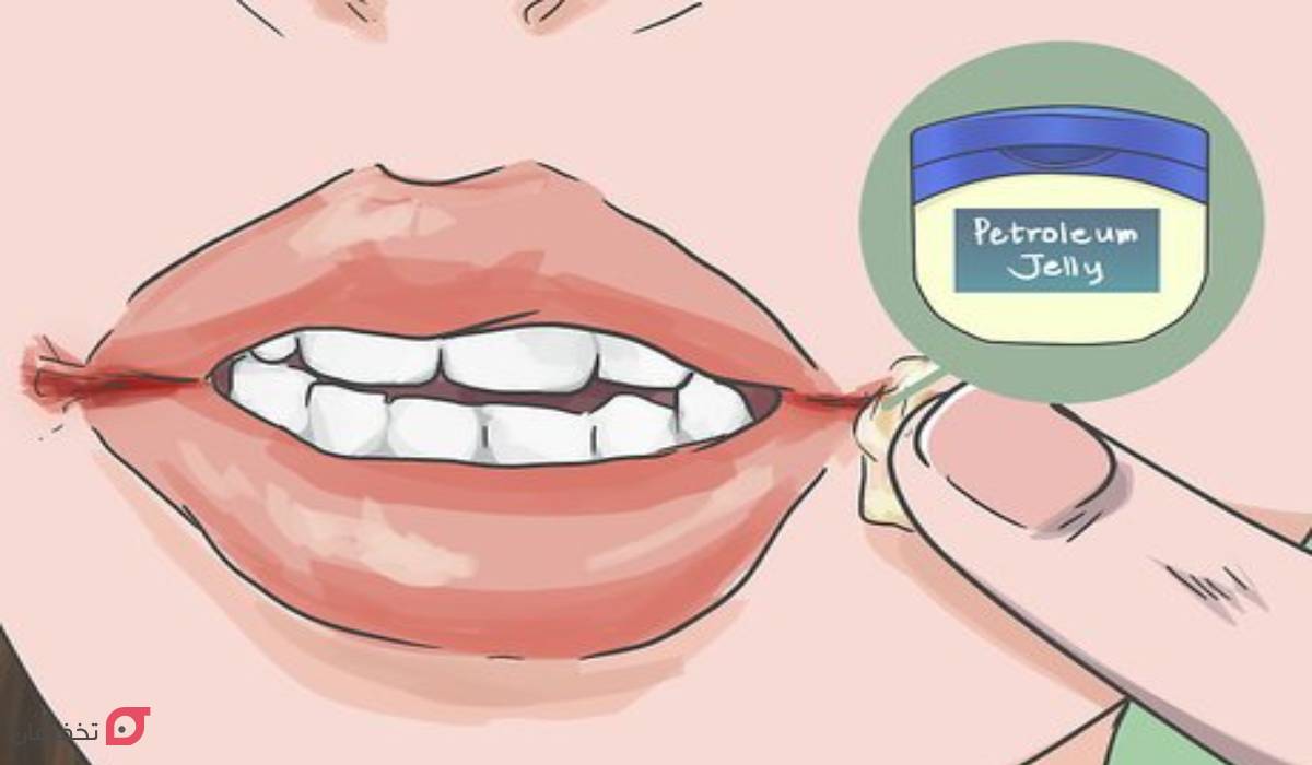 کمبود کدام ویتامین باعث ترک گوشه لب میشود؟ 8 درمان ترک گوشه لب