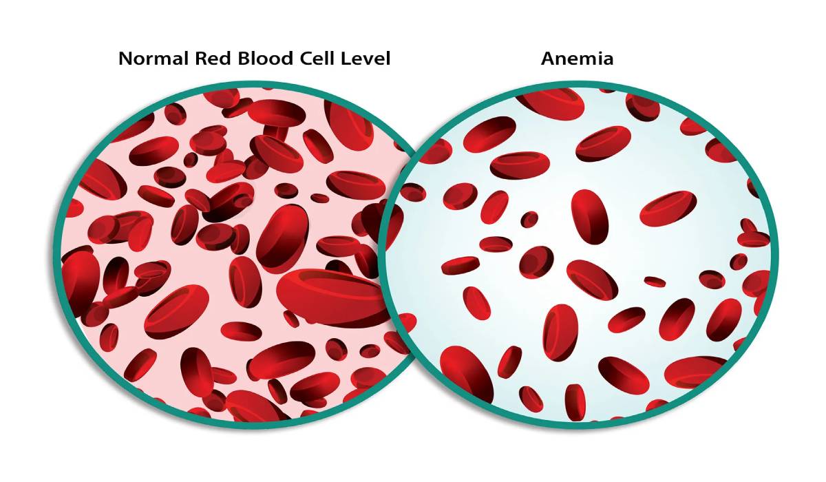 علائم کمبود آهن در مردان؛ علت و عوارض + 6 درمان سریع 2 کمبود آهن چیست؟