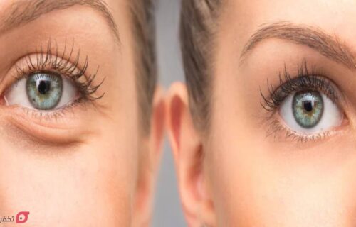 عکس قبل و بعد از تزریق ژل زیر چشم