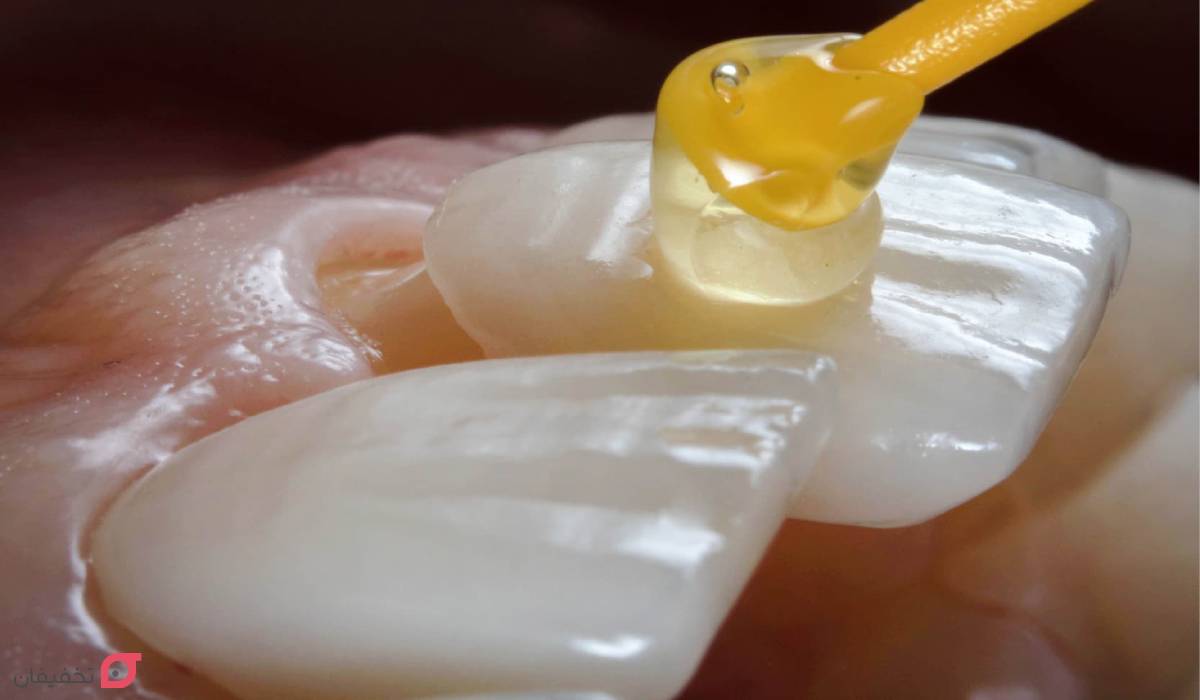 مراحل لمینت دندان با عکس | 11 مرحله با توضیح کامل و تصاویر 6 مراحل لمینت دندان با عکس