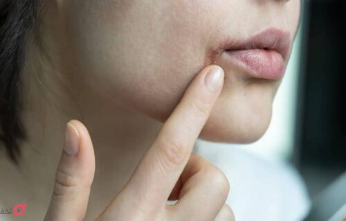 کمبود کدام ویتامین باعث ترک گوشه لب میشود؟ 32 کمبود کدام ویتامین باعث ترک گوشه لب میشود؟