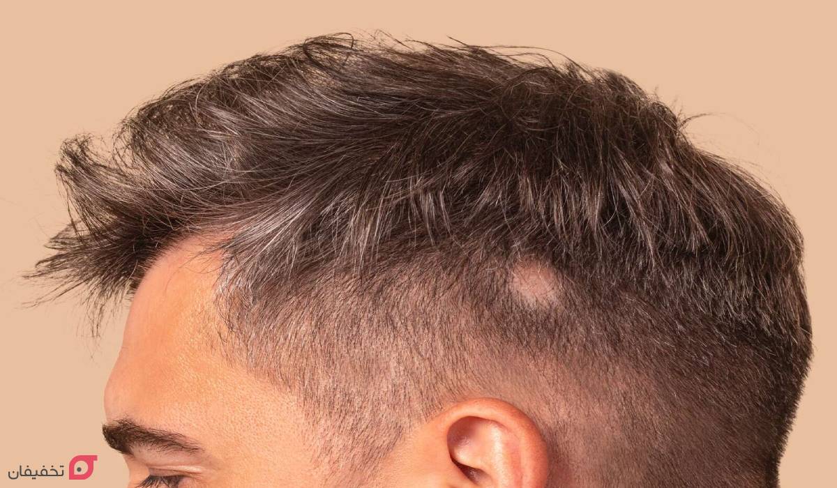 انواع ریزش مو و دلایل آن؛ نحوه تشخیص الگو و نوع ریزش با عکس 5 انواع ریزش مو