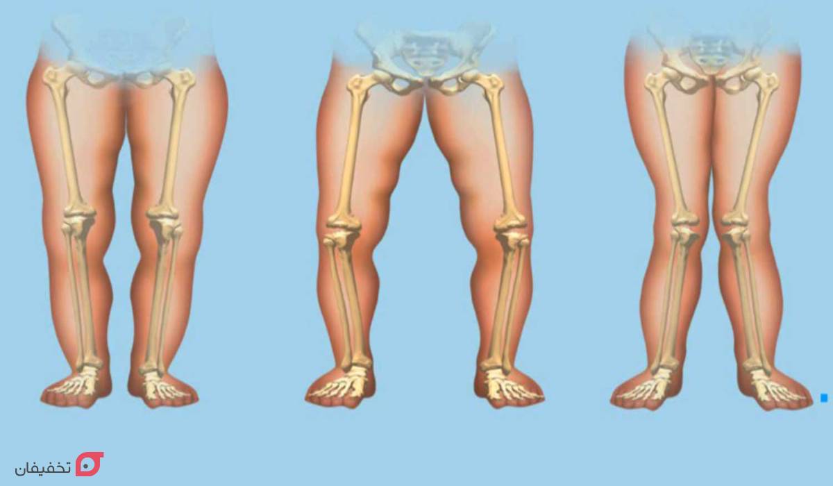نرمی استخوان چیست | علت، علائم و درمان قطعی خانگی بزرگسالان 3 علت نرمی استخوان