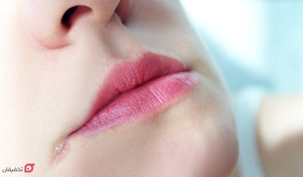 کمبود کدام ویتامین باعث ترک گوشه لب میشود؟ 3 علت ترک گوشه لب