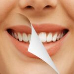 تفاوت لمینت و کامپوزیت و بلیچینگ | ماندگاری، هزینه و مزایا 28 تفاوت لمینت و کامپوزیت و بلیچینگ