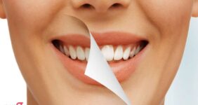 تفاوت لمینت و کامپوزیت و بلیچینگ