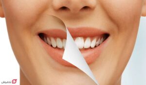 تفاوت لمینت و کامپوزیت و بلیچینگ | ماندگاری، هزینه و مزایا