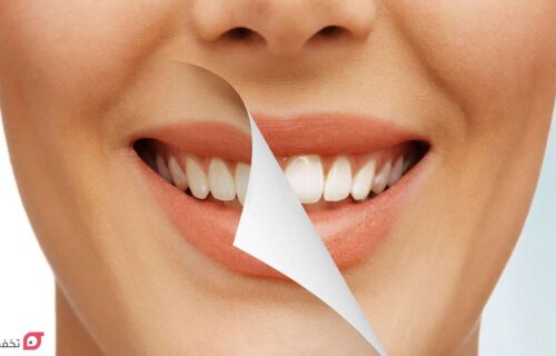 تفاوت لمینت و کامپوزیت و بلیچینگ | ماندگاری، هزینه و مزایا 22 تفاوت لمینت و کامپوزیت و بلیچینگ