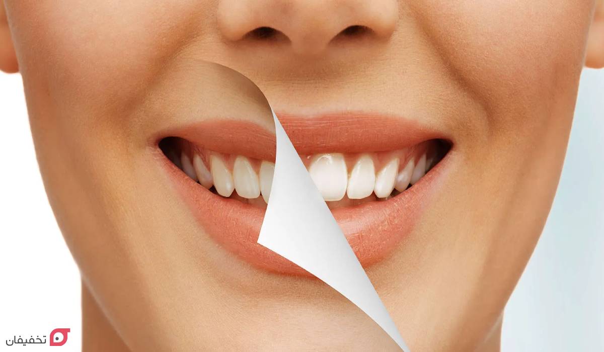 تفاوت لمینت و کامپوزیت و بلیچینگ