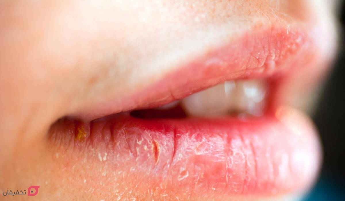 کمبود کدام ویتامین باعث ترک گوشه لب میشود؟ 4 ترک گوشه لب