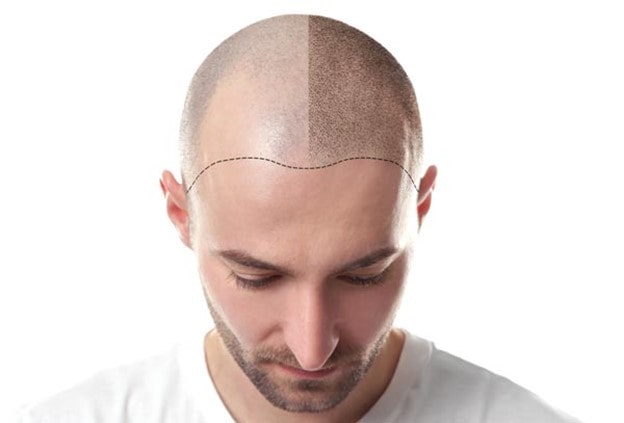 کاشت مو به روش ترکیبی؛ مراحل، مزایا، معایب و هزینه 2 کاشت ترکیبی مو min